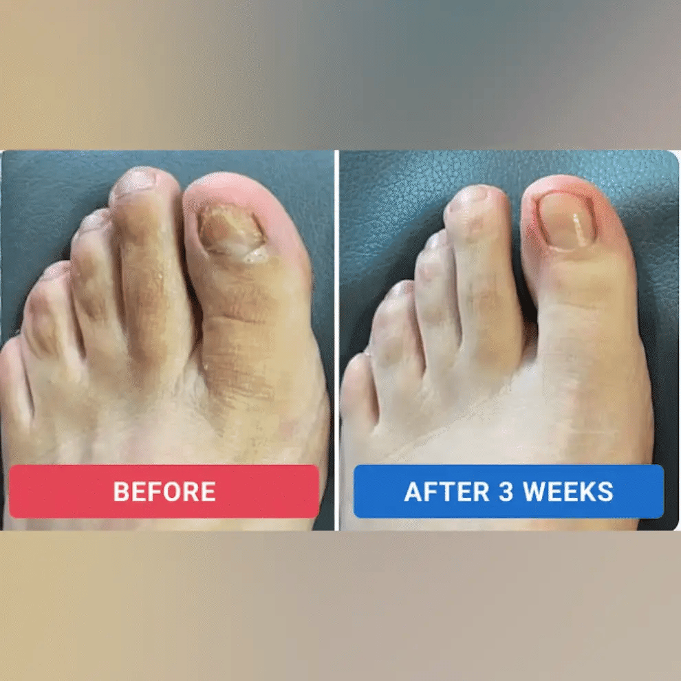 Patchs réparateurs pour ongles Sereolys